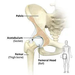 Anatomical illustration of a human hip joint showing the pelvis, acetabulum (socket), femur (thigh bone), and femoral head (ball), with a small full-body silhouette for scale.